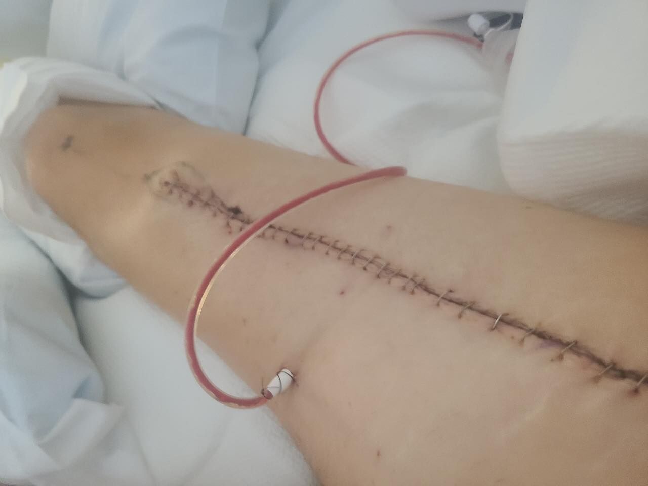 Cancer survivor wakes up from surgery without his right eye and confused by multiple scars